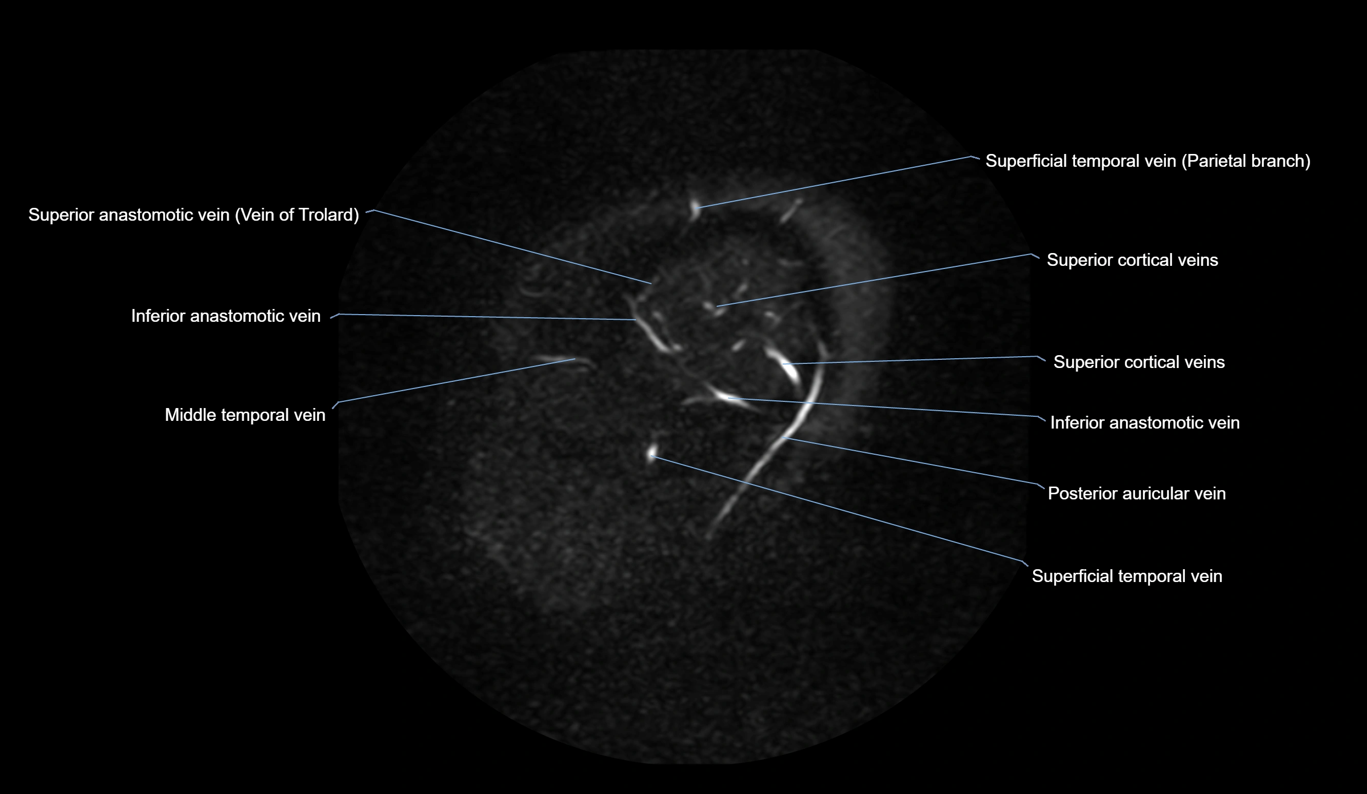 MRV brain sagittal anatomy 3T MRI labelledimages -00012.webp